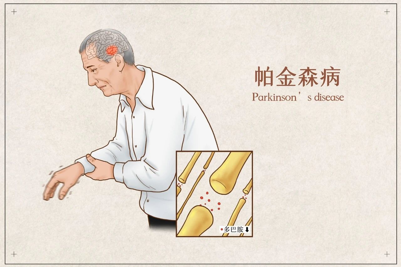 世界帕金森日 | 别怕“帕”，早发现早治疗！