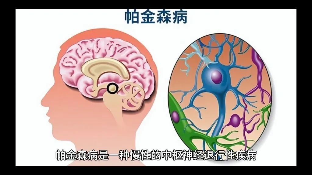 世界帕金森日 | 别怕“帕”，早发现早治疗！