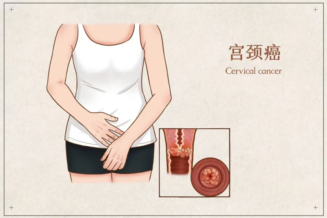 为什么年年体检正常，一查出来就是癌症晚期?