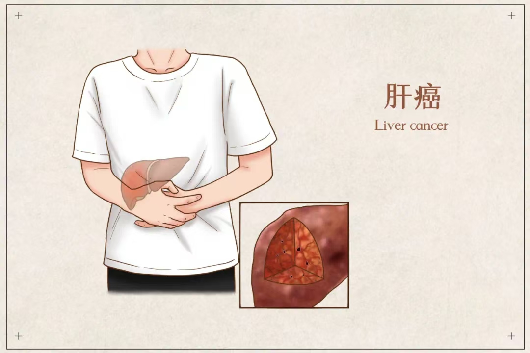 为什么年年体检正常，一查出来就是癌症晚期?