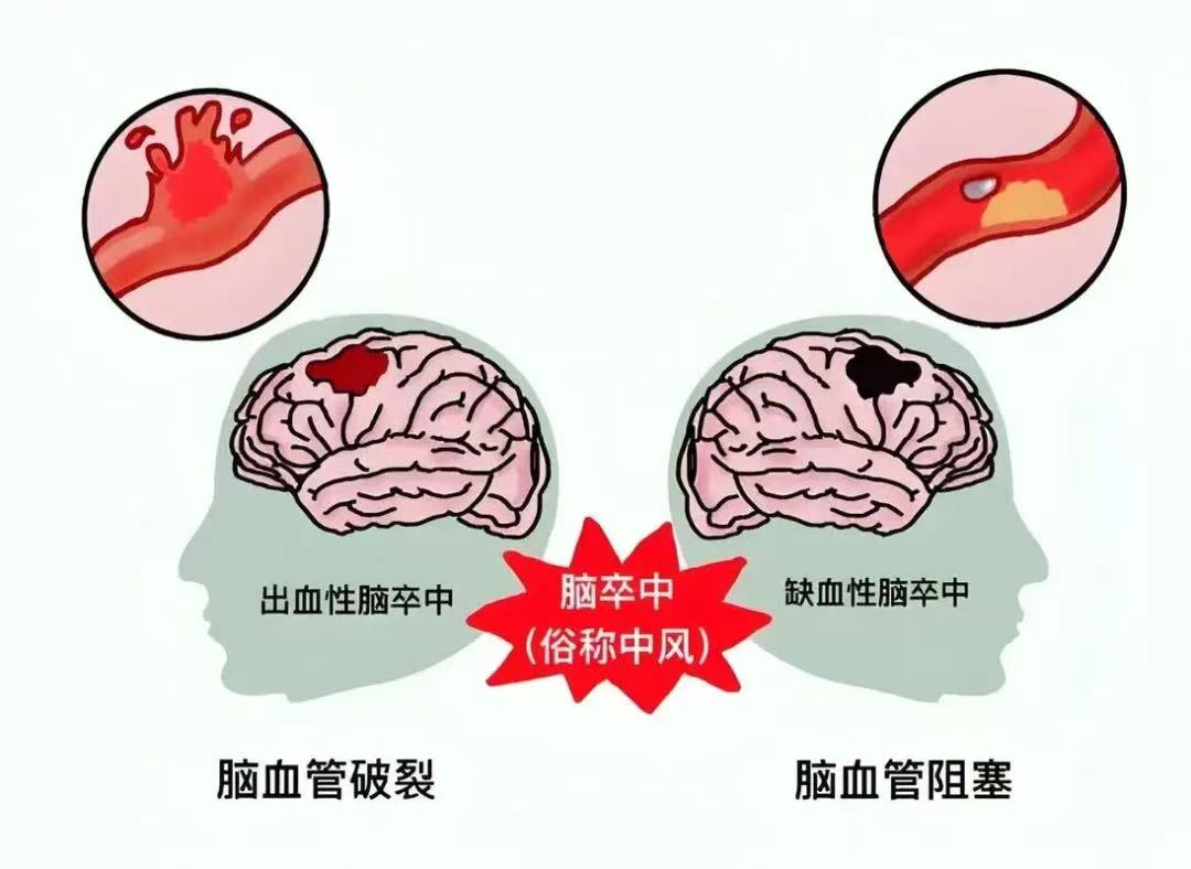 世界卒中日 | 了解卒中，守护健康！