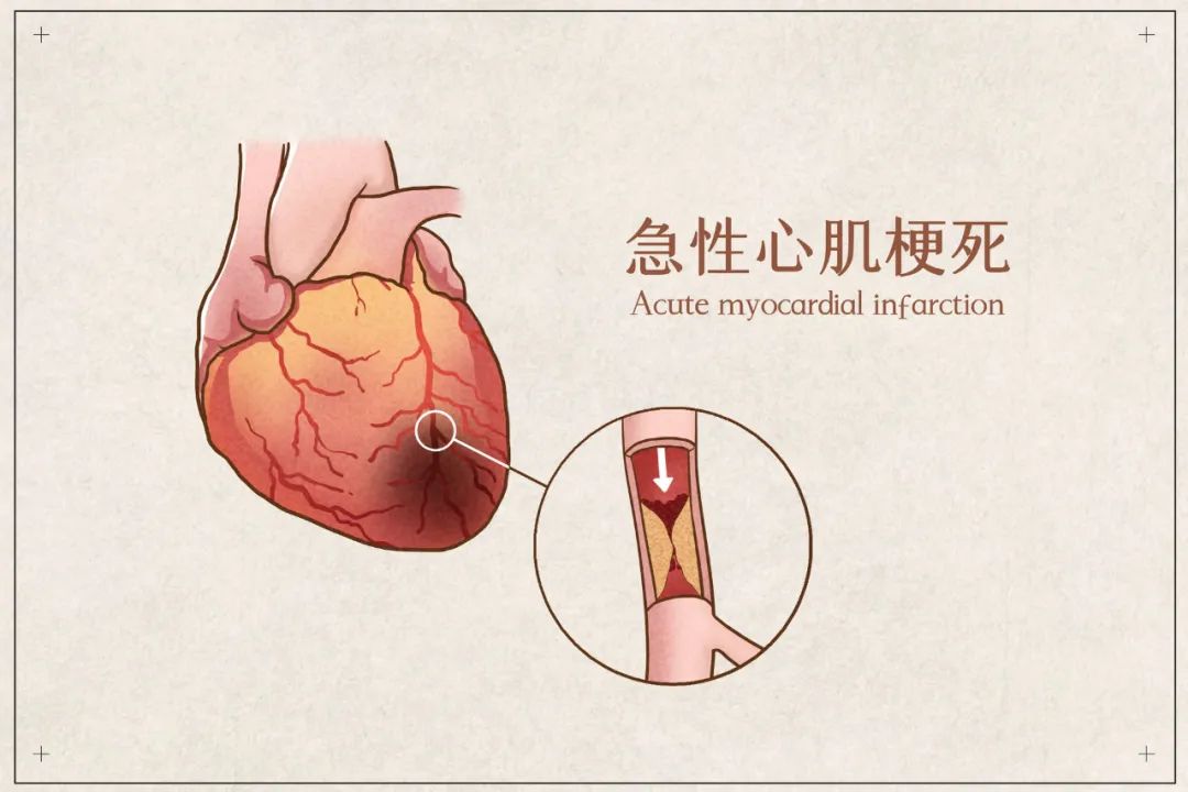 冬季心脑血管疾病高发，如何做好科学防护？