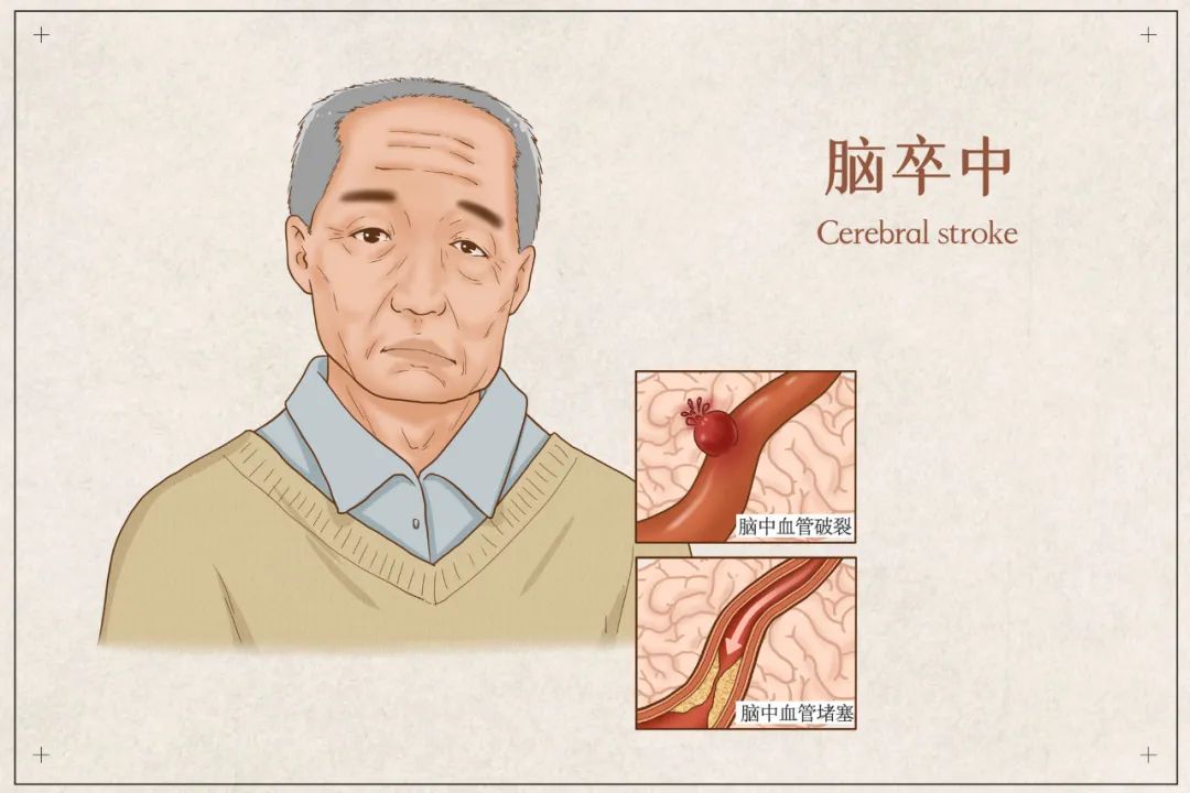 冬季心脑血管疾病高发，如何做好科学防护？