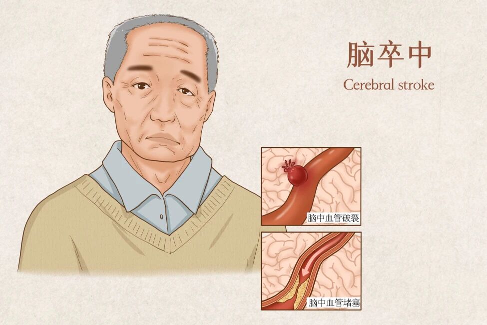 别等中风才后悔!5个低成本护脑习惯,现在就能做
